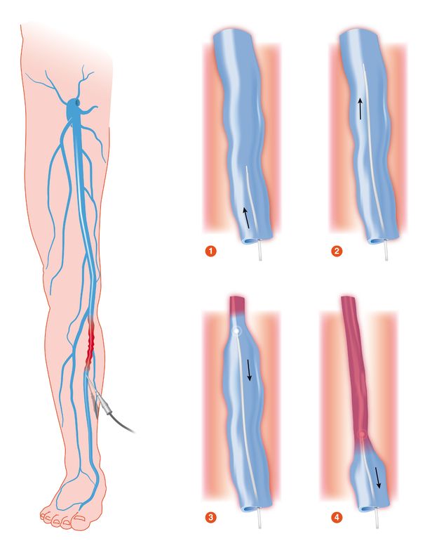 Laser treatment of varicose veins