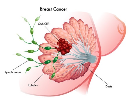 Mammary cancer