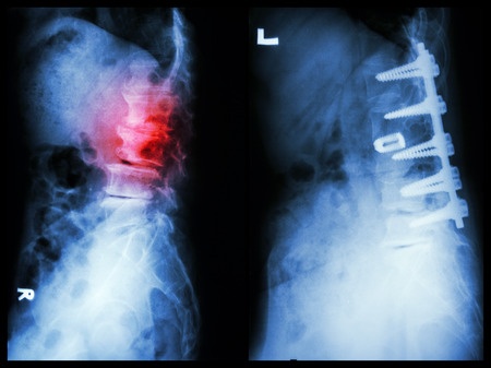 Operation with internal fixation of vertebrae