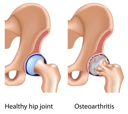 Osteoarthritit