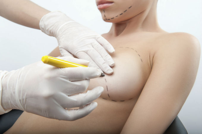 Plastic surgery for breast augmentation