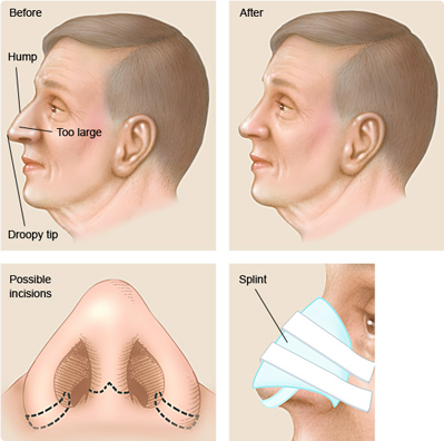 Plastic surgery of the nose