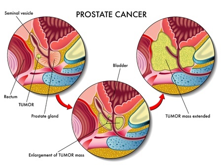 Prostate cancer