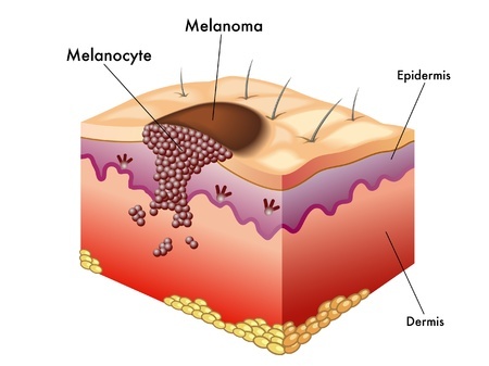 The spread of melanoma