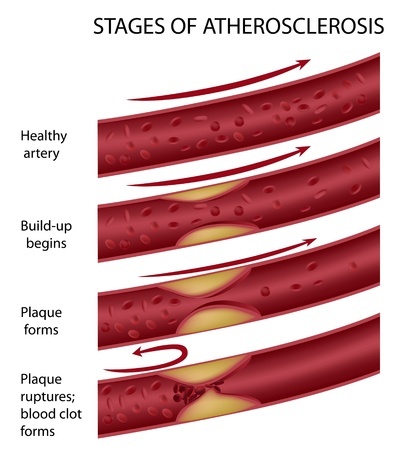 Stages of atherosclerosis