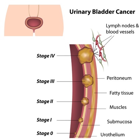 Stages of bladder cancer