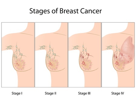 Stages of Breast Cancer