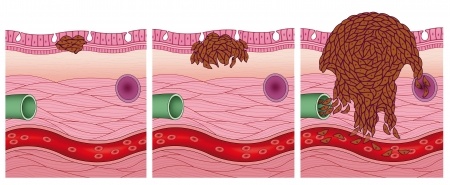 Stages of melanoma