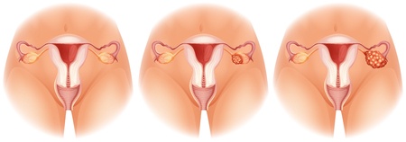 Stages of Ovarian Cancer