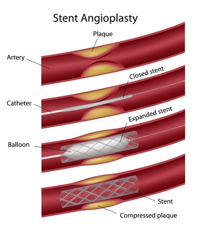 Stent angioplasty