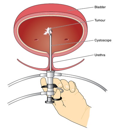 The study of bladder cancer using a cystoscope