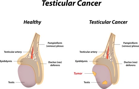 Testicular cancer