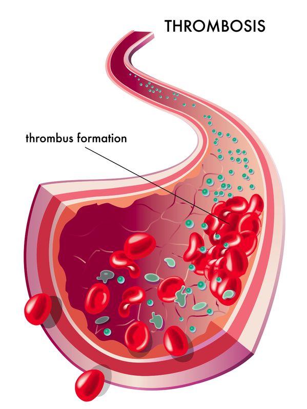 Thrombus - blood clot formation