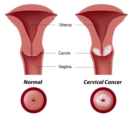 Treatment of cervical cancer