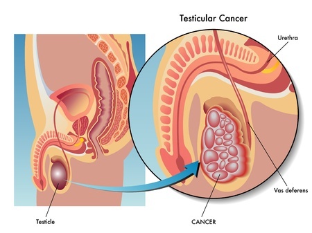Treatment of testicular cancer