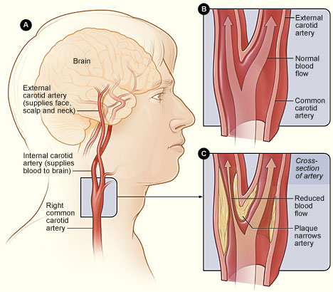 Carotid artery disease