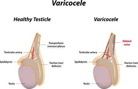 Varicocele